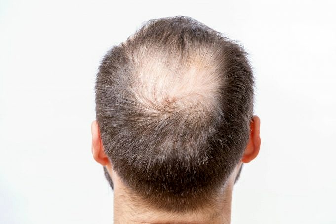 Cinq Raisons Pour Lesquelles Les Hommes Perdent Leurs Cheveux